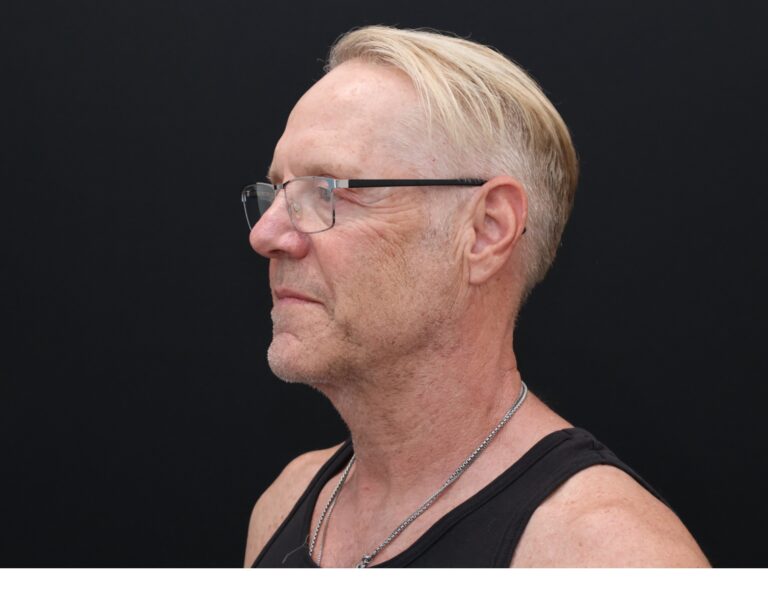 Before Image: Necklift - left-front-oblique
