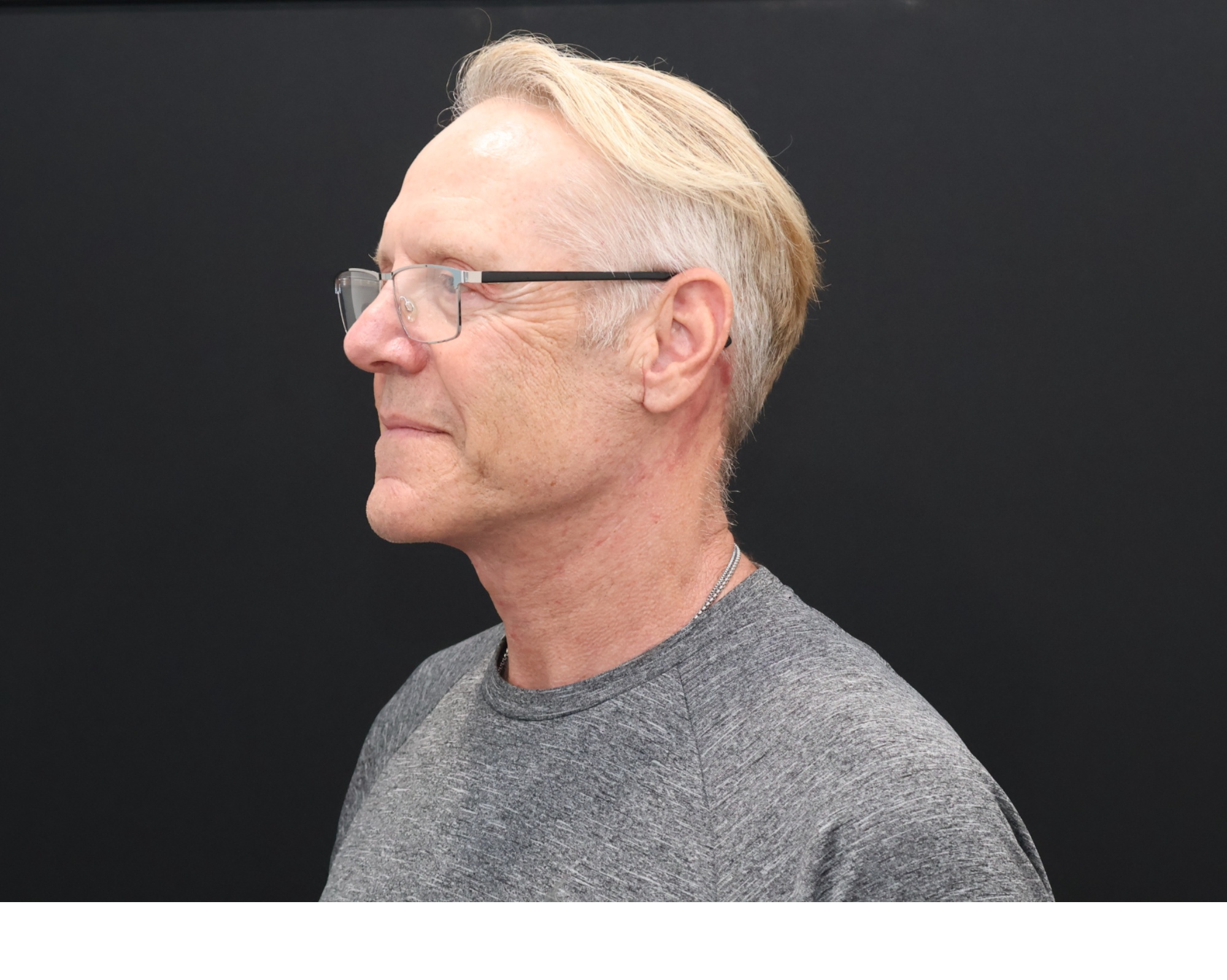 After Image: Necklift - left-front-oblique