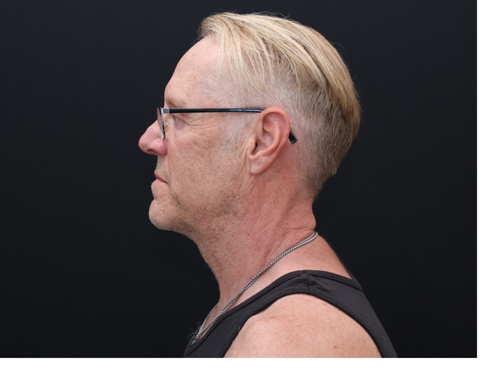 Before Image: Necklift - left-side
