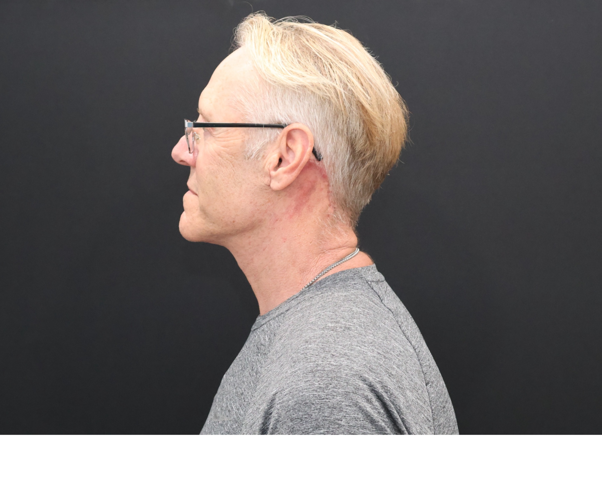 After Image: Necklift - left-side