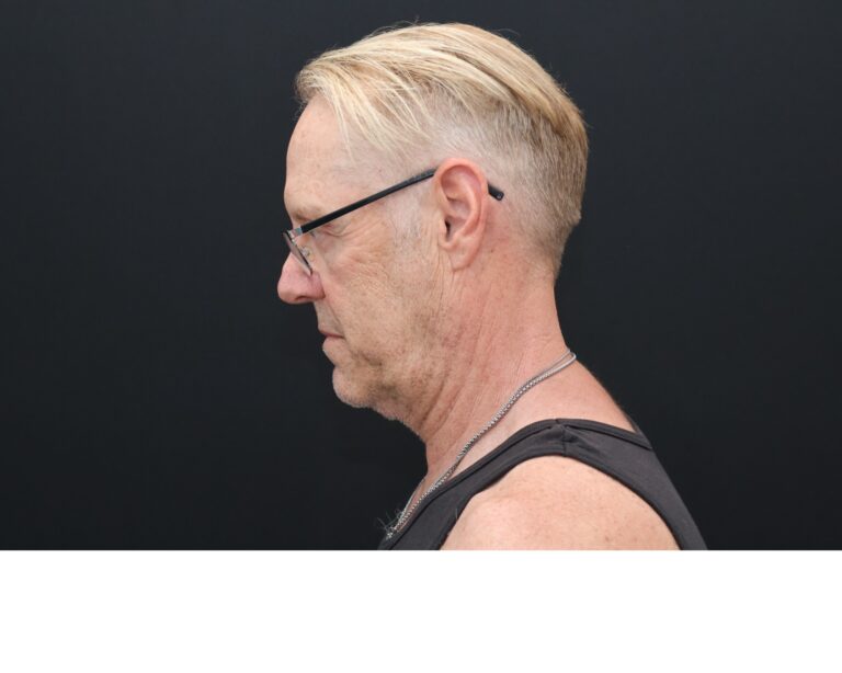 Before Image: Necklift - left-side