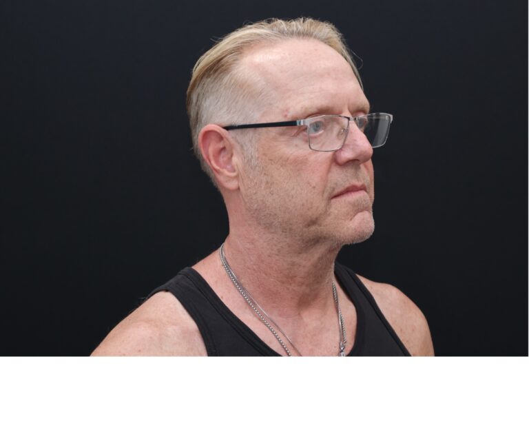 Before Image: Necklift - right-front-oblique
