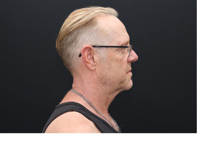 Before Image: Necklift - right-side