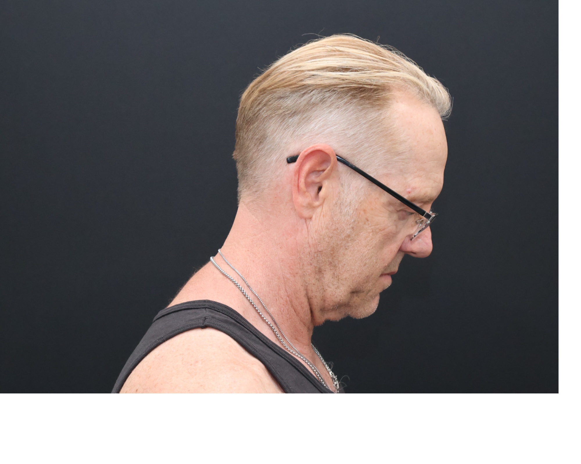 Before Image: Necklift - right-side