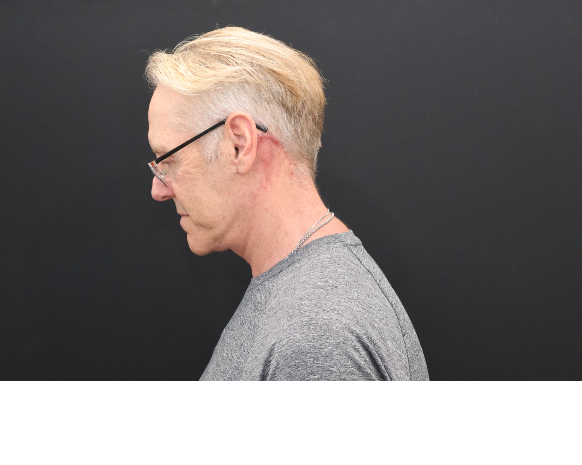 After Image: Necklift - left-side