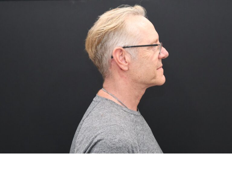 After Image: Necklift - right-side