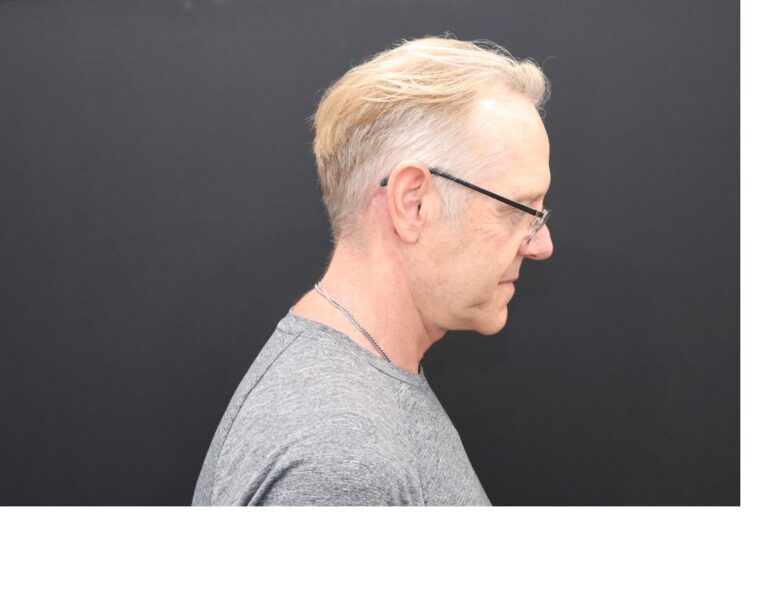 After Image: Necklift - right-side