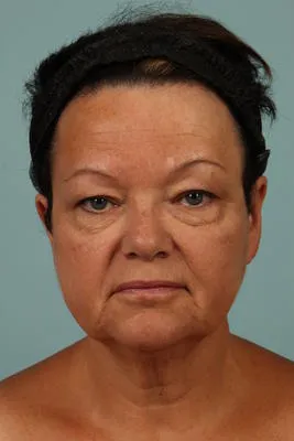 Before Image: Blepharoplasty - front