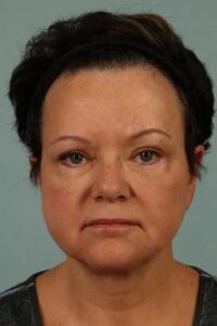After Image: Blepharoplasty