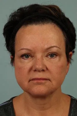 After Image: Blepharoplasty - front