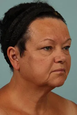Before Image: Blepharoplasty - right-front-oblique