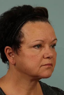After Image: Blepharoplasty - right-front-oblique