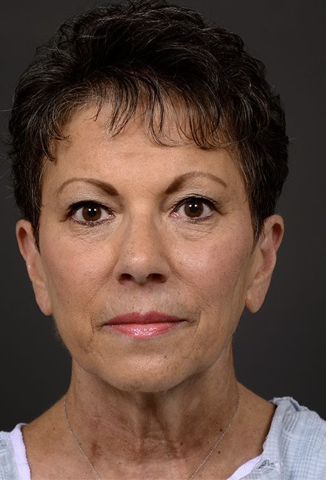 Before Image: Facelift - front