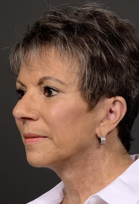 After Image: Facelift - left-front-oblique