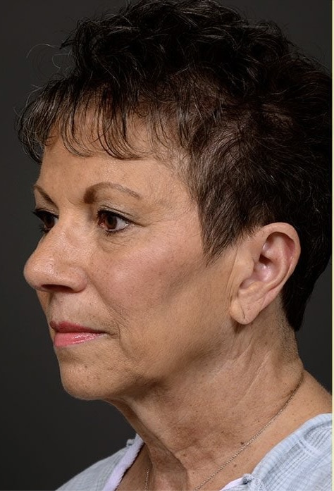 Before Image: Facelift - left-front-oblique