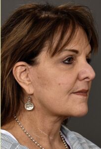 After Image: Facelift