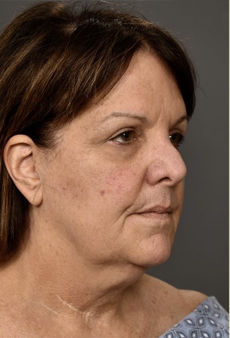 Before Image: Facelift - right-front-oblique