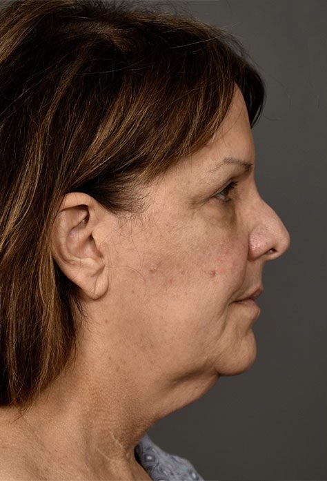 Before Image: Facelift - right-side
