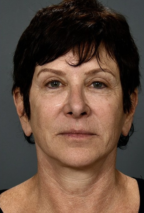 After Image: Facelift - front
