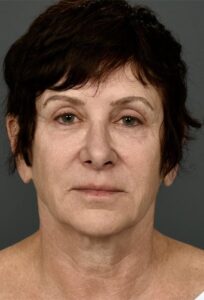 Before Image: Facelift