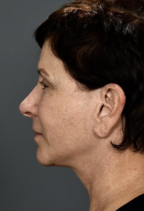 After Image: Facelift - left-side