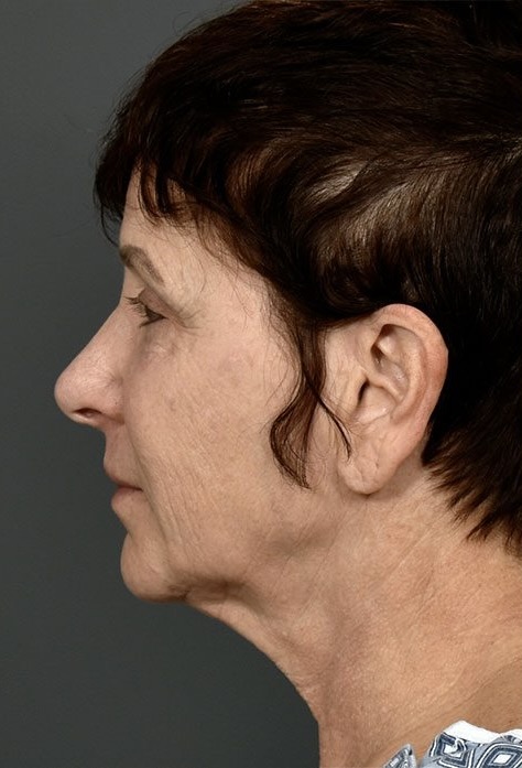 Before Image: Facelift - left-side