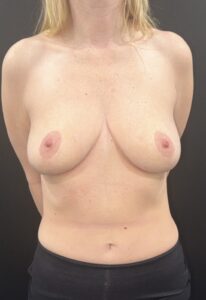 Before Image: This is a 36 year old female who had a breast augmentation in San Diego, CA