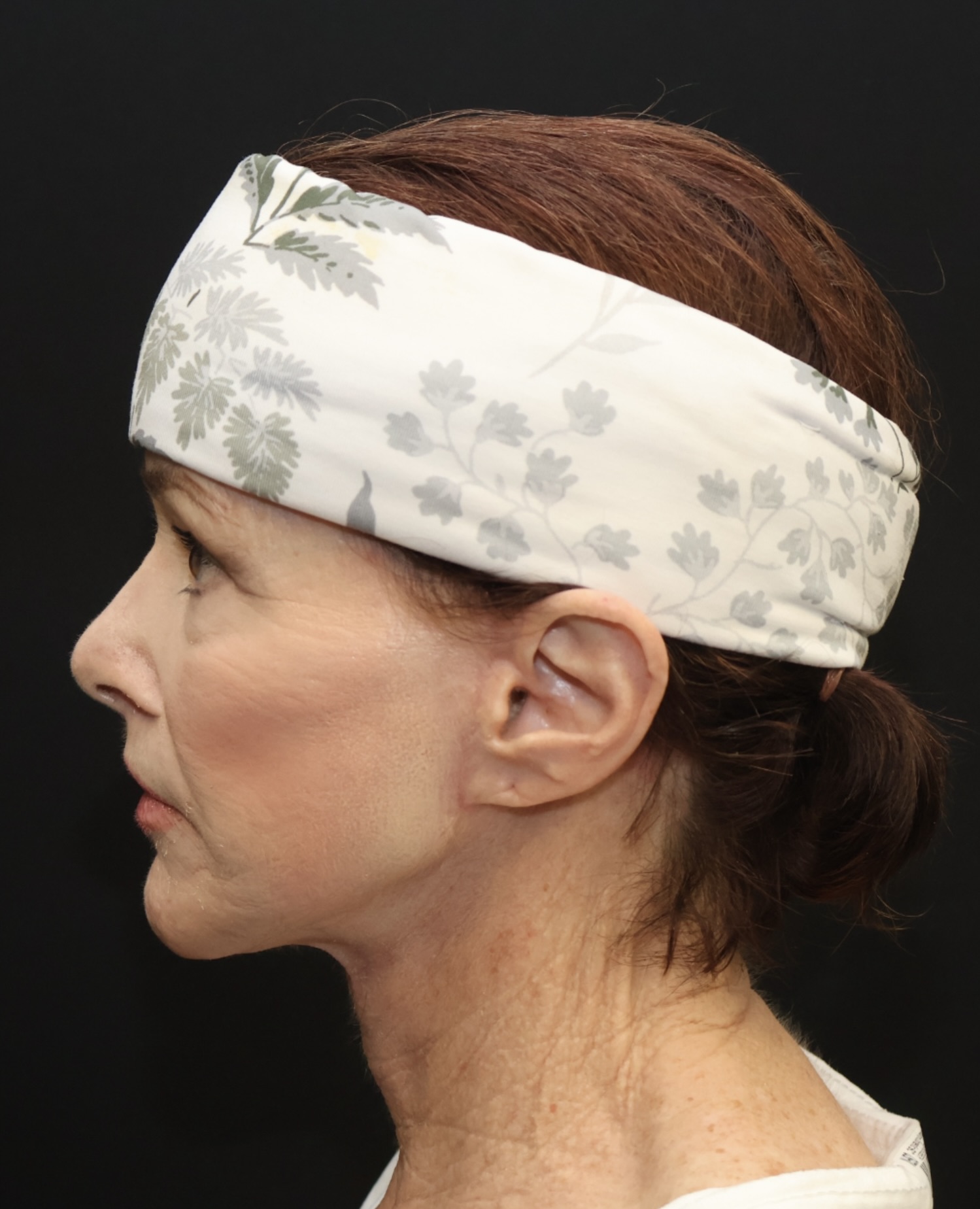 After Image: Facelift & Neck Lift Transformation: A 67-Year-Old Patient Prepares for Her Son’s Wedding - front