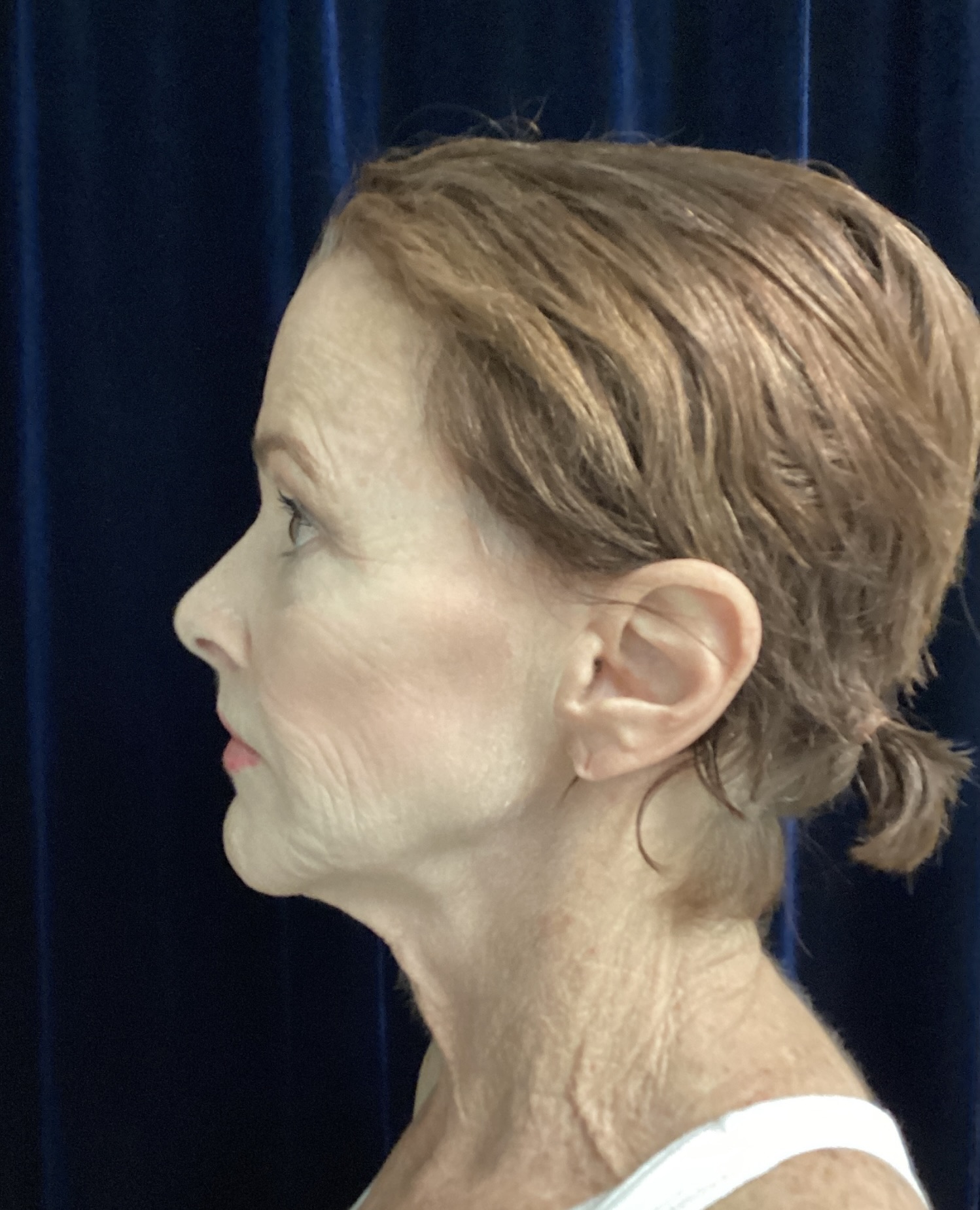 Before Image: Facelift & Neck Lift Transformation: A 67-Year-Old Patient Prepares for Her Son’s Wedding - front