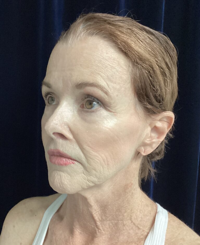 Before Image: Facelift & Neck Lift Transformation: A 67-Year-Old Patient Prepares for Her Son’s Wedding - left-front-oblique