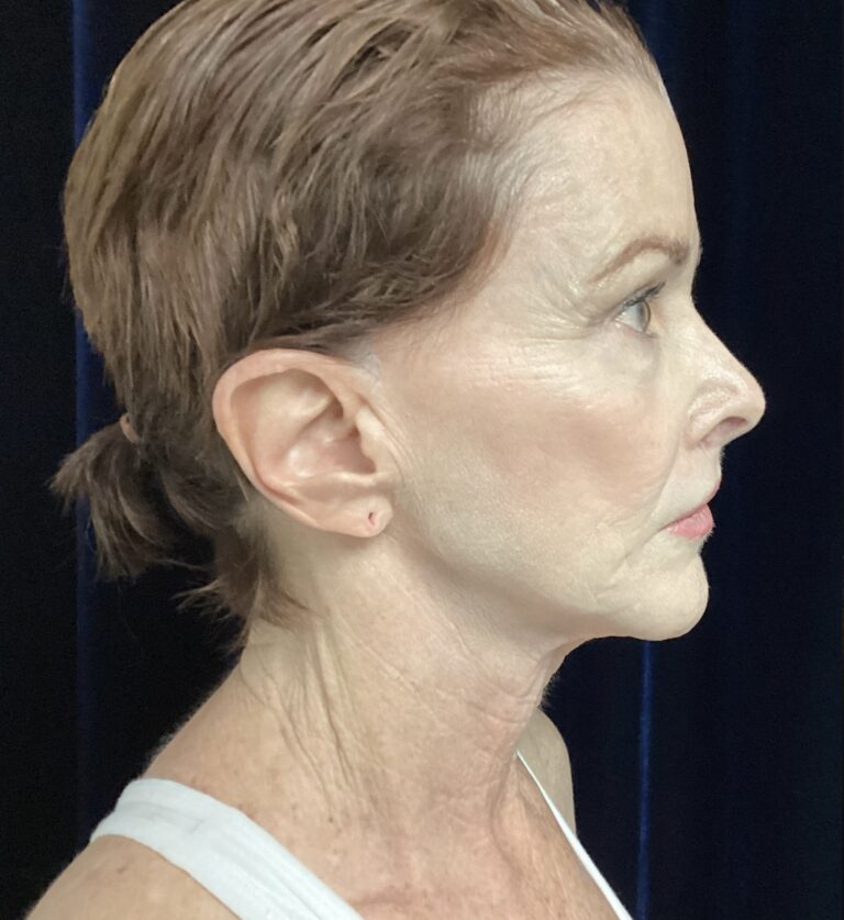Before Image: Facelift & Neck Lift Transformation: A 67-Year-Old Patient Prepares for Her Son’s Wedding - right-side