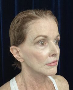 Before Image: Facelift & Neck Lift Transformation: A 67-Year-Old Patient Prepares for Her Son’s Wedding
