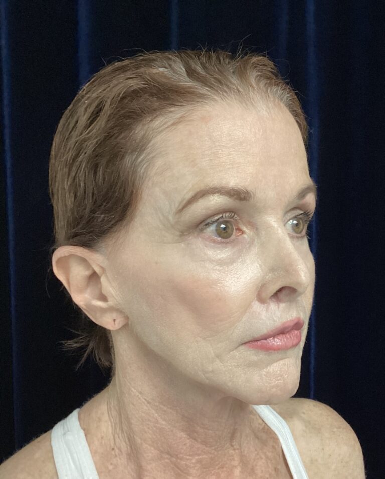 Before Image: Facelift & Neck Lift Transformation: A 67-Year-Old Patient Prepares for Her Son’s Wedding - right-front-oblique