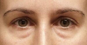 Before Image: Eyelid Surgery