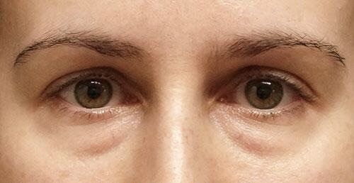Before Image: Eyelid Surgery - front