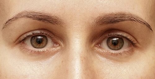 After Image: Eyelid Surgery - front