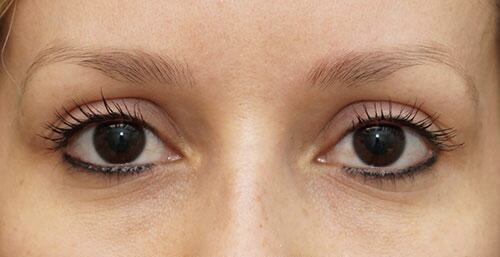 After Image: Eyelid Surgery - front