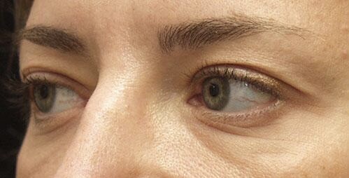 Before Image: Eyelid Surgery - left-front-oblique