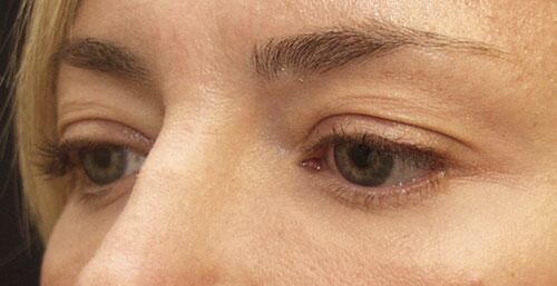 After Image: Eyelid Surgery - left-front-oblique