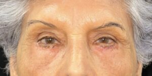 After Image: Eyelid Surgery