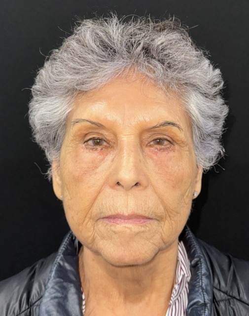 After Image: Facial Fat Transfter - front