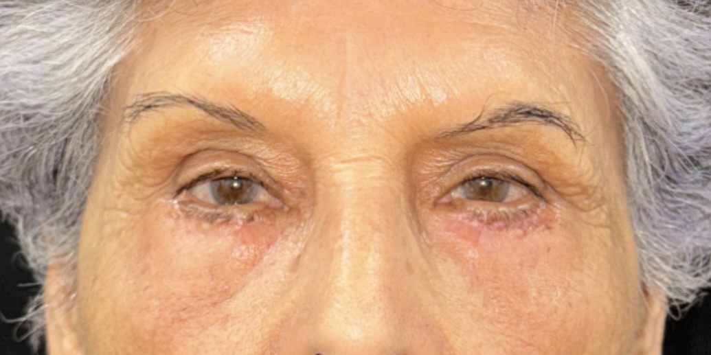 After Image: Eyelid Surgery - front