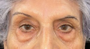 Before Image: Eyelid Surgery