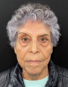 Before Image: Facial Fat Transfter