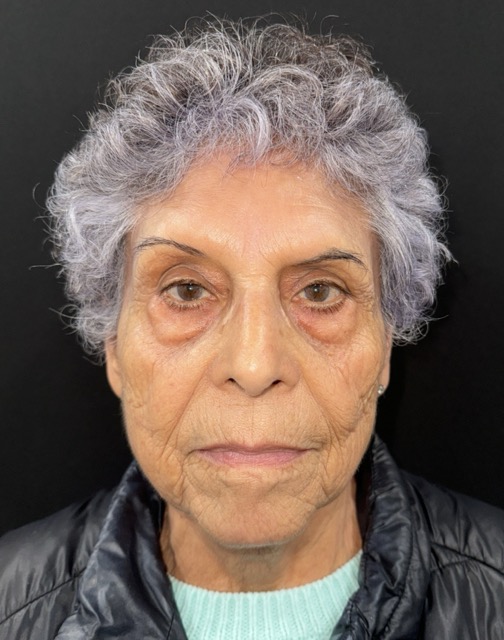 Before Image: Facial Fat Transfter - front