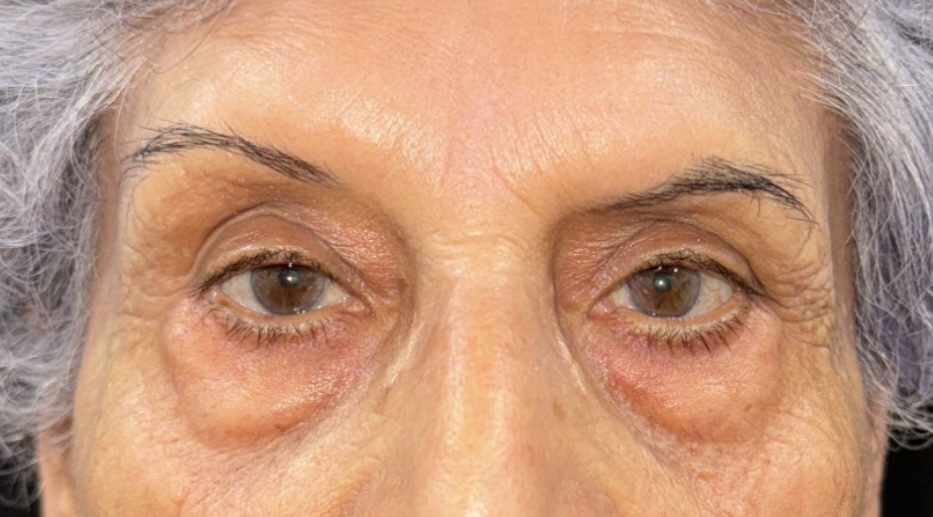 Before Image: Eyelid Surgery - front