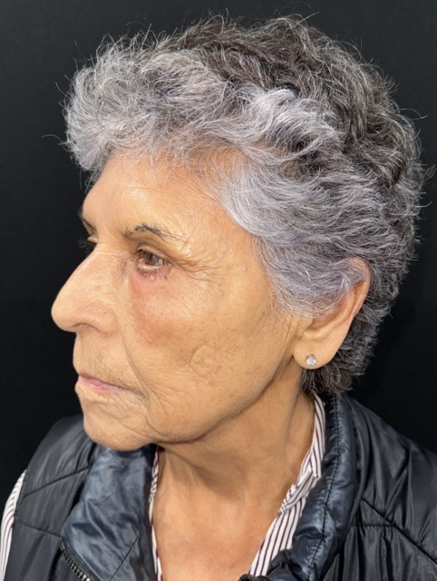 After Image: Facial Fat Transfter - left-front-oblique