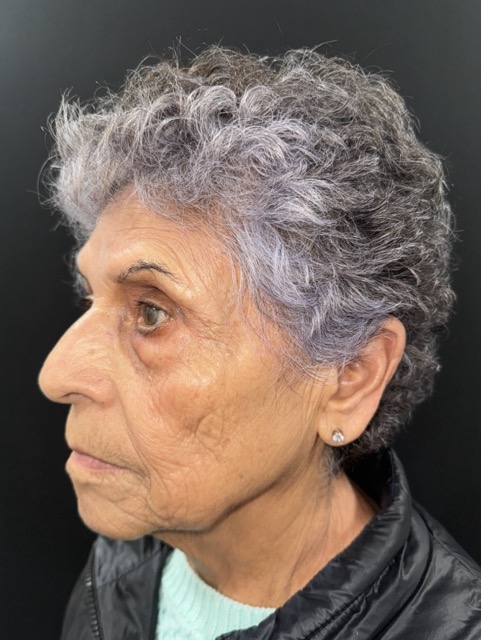 Before Image: Facial Fat Transfter - left-front-oblique