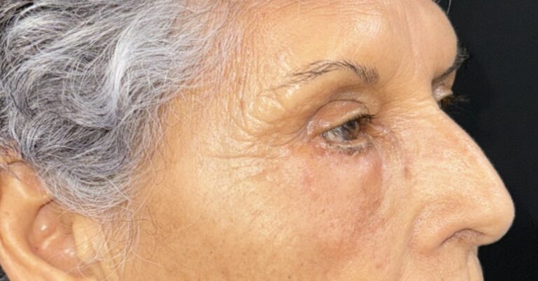 After Image: Eyelid Surgery - right-front-oblique