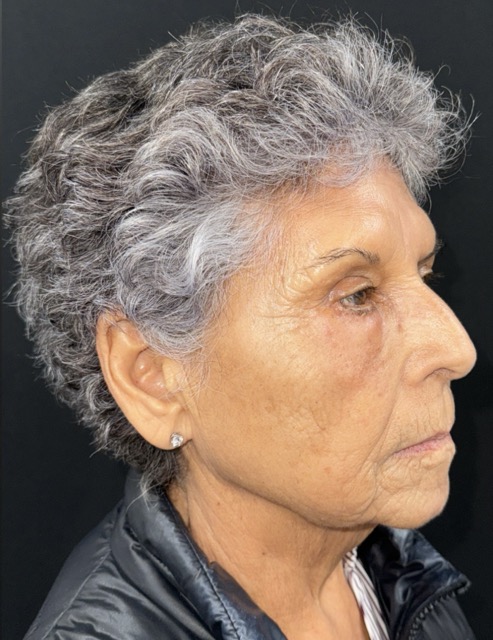 After Image: Facial Fat Transfter - right-front-oblique